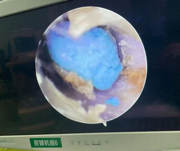 危险!4岁孩子模仿孙悟空,把“金箍棒”塞进耳朵 危险!4岁孩子模仿孙悟空,把“金箍棒”塞进耳朵