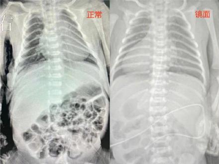 “逆向”打通!早产儿内脏长反了也没难住医生 “逆向”打通!早产儿内脏长反了也没难住医生