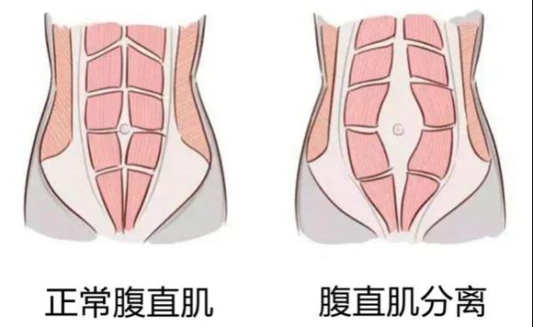 束腹带能瘦身？小心是智商税！康复治疗师教你产后恢复小蛮腰