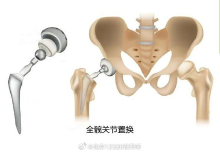 换了人工关节后能用多久？如果坏了能不能再做手术换一个？