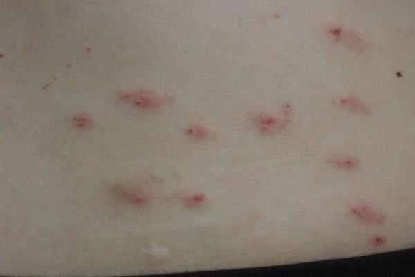 一对情侣躺着看了场电影，全身长满这东西