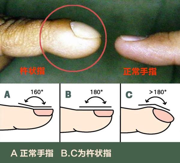 手指长这样，可能是肺癌信号？