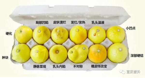 乳腺癌早期的6个危险信号