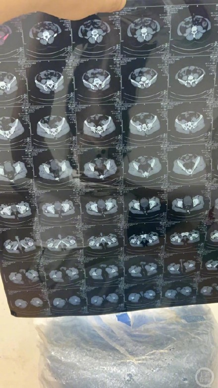 在“是男还是女”困境挣扎33年的罕见病患者:我只想做个正常人 在“是男还是女”困境挣扎33年的罕见病患者:我只想做个正常人