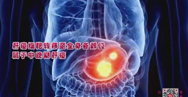 肿瘤之王?发现等于生命倒计时?专家:1/3有望治愈! 肿瘤之王?发现等于生命倒计时?专家:1/3有望治愈!