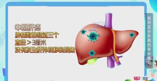 肿瘤之王?发现等于生命倒计时?专家:1/3有望治愈! 肿瘤之王?发现等于生命倒计时?专家:1/3有望治愈!