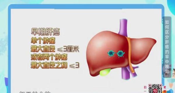 肿瘤之王?发现等于生命倒计时?专家:1/3有望治愈! 肿瘤之王?发现等于生命倒计时?专家:1/3有望治愈!