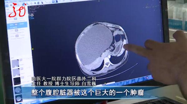 震惊!医生在15岁少女肚子中取出近35斤的肿瘤......啥病? 震惊!医生在15岁少女肚子中取出近35斤的肿瘤......啥病?