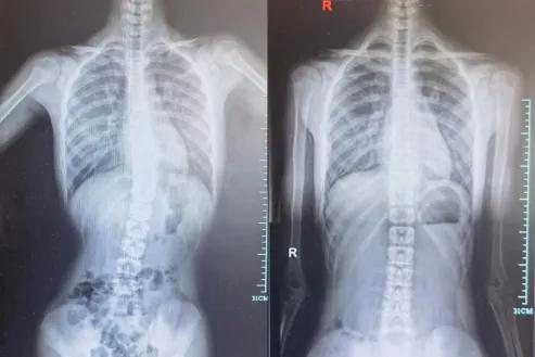 11岁男孩脊柱侧弯，这病愈发常见！