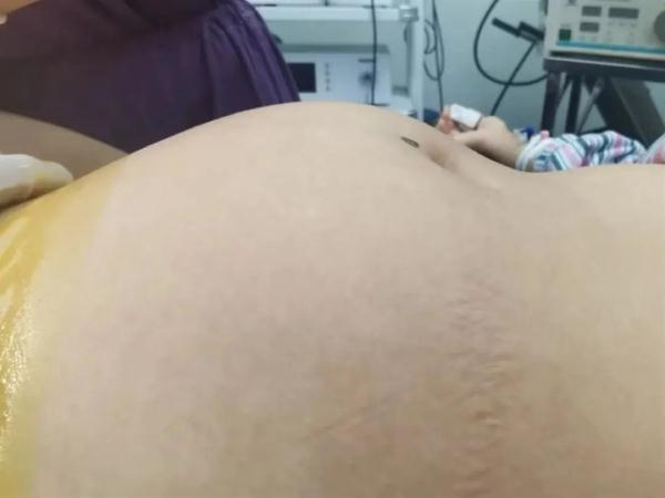 19岁未婚女子腹内长肿瘤，剖开竟然有头发、牙齿等人体组织