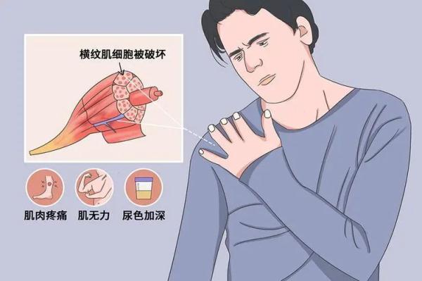 高中生集训三天后全身乏力还出现“酱油尿”!夏季运动,谨防横纹肌溶解 高中生集训三天后全身乏力还出现“酱油尿”!夏季运动,谨防横纹肌溶解