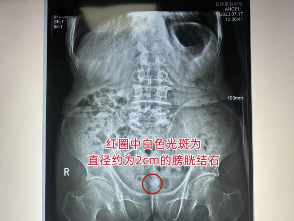 83岁嗲嗲突发尿痛尿血，紧急就医“揪出”暗藏体内的膀胱结石