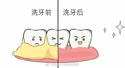 洗牙是怎么回事？