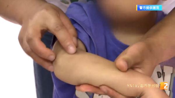 被蚂蚁咬后,昆明一4岁男孩两度昏迷……注意这些情况会引发严重反应! 被蚂蚁咬后,昆明一4岁男孩两度昏迷……注意这些情况会引发严重反应!