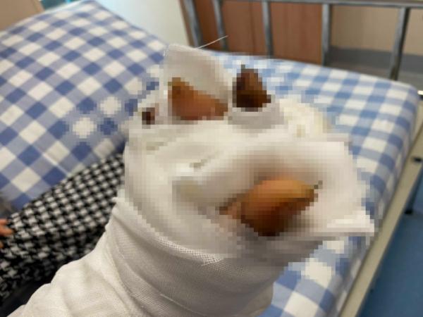 揪心！一周内3例手指切断，医生巧手再接7根手指