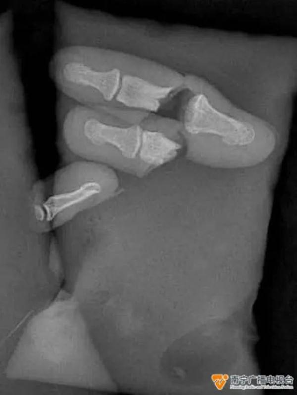 揪心！一周内3例手指切断，医生巧手再接7根手指