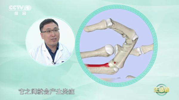 【养生】经常做这5个动作的你,小心腱鞘炎找上门!快试试这2个方法 【养生】经常做这5个动作的你,小心腱鞘炎找上门!快试试这2个方法