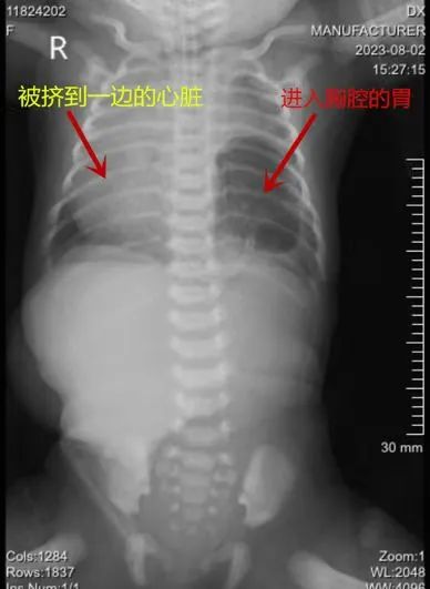 新生儿X光片吓坏医生：肝跑了、心偏了、胃不见了…