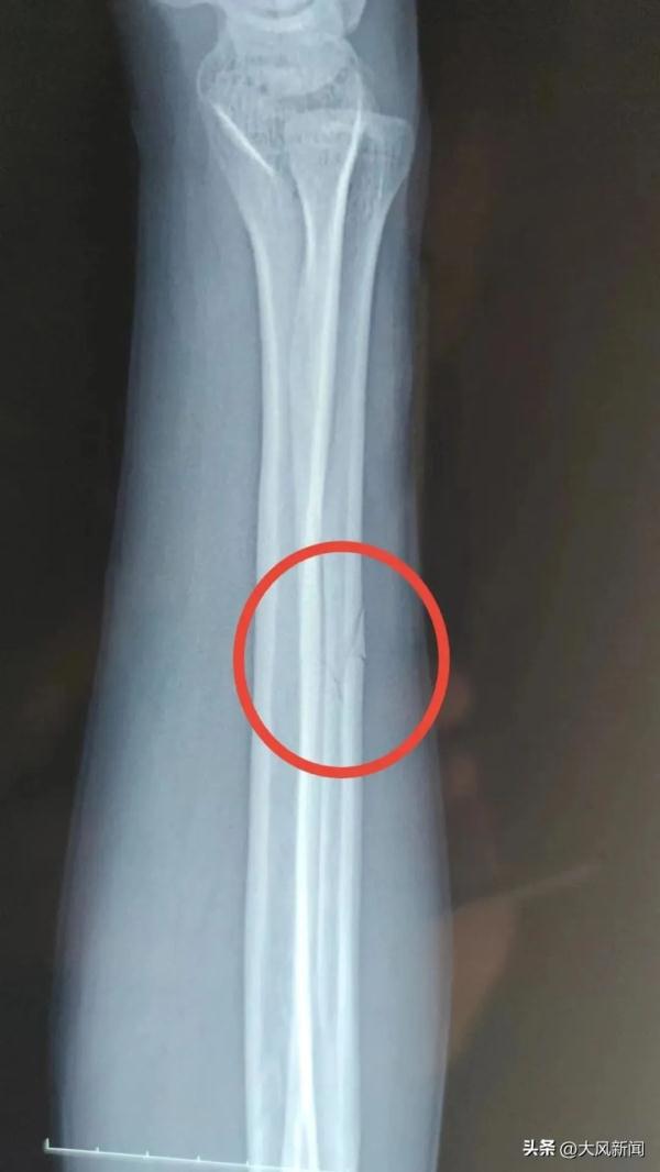 民警酒后殴打残疾人！警方凌晨通报