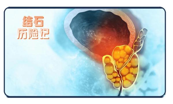 固体钙吃多了会得肾结石?"钙":这锅我不背! 固体钙吃多了会得肾结石?"钙":这锅我不背!