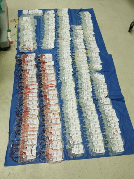 输血超6万毫升，羊水栓塞产妇被救了！医生：五类孕产妇是高危人群