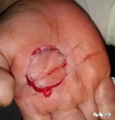 万万没想到的"伤人狂魔"！有人差点被割断血管！这种拖把很多人家里有