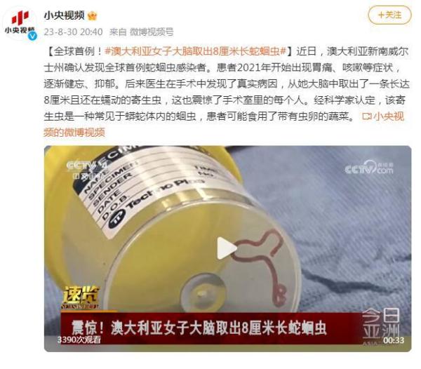 全球首例！澳大利亚女子大脑取出8厘米长蛇蛔虫