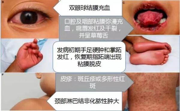高烧不退!郑州已有多名孩子确诊,医生重要提醒→ 高烧不退!郑州已有多名孩子确诊,医生重要提醒→