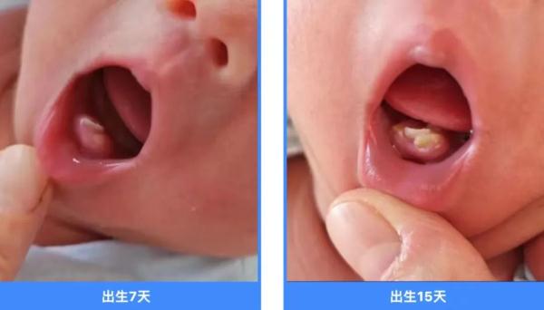 出生15天,就长了2颗牙? 出生15天,就长了2颗牙?