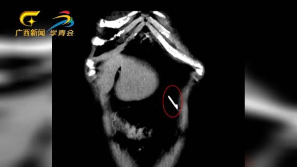 女子赌气吞下一把缝衣针,30多年后手术“捞针” 女子赌气吞下一把缝衣针,30多年后手术“捞针”