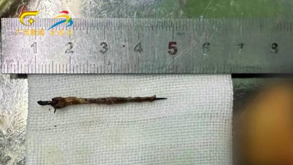 女子赌气吞下一把缝衣针,30多年后手术“捞针” 女子赌气吞下一把缝衣针,30多年后手术“捞针”