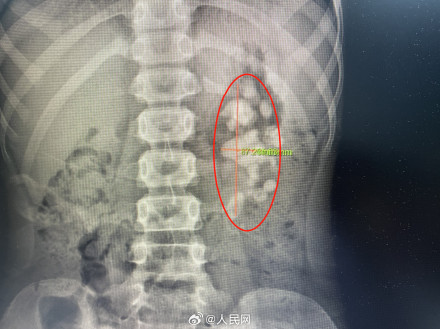 10岁男童左肾长满鹿角型结石 10岁男童左肾长满鹿角型结石