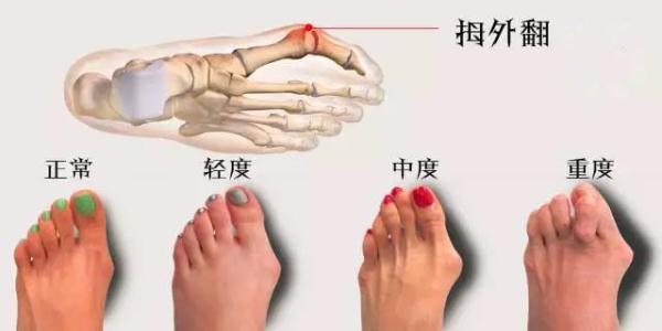 大医生开讲｜大脚趾长歪了，小心是“踇外翻”！女性更要警惕
