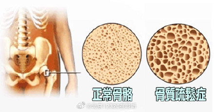 骨质疏松症的主要症状是什么？
