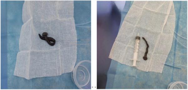 女子气管内藏着8厘米蚂蟥！取出时还在蠕动