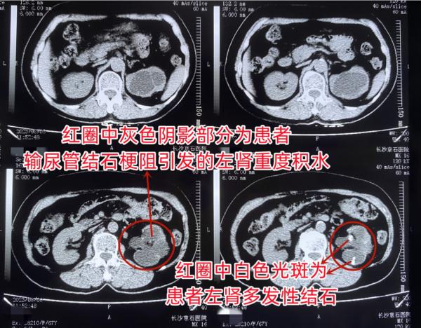 结石不痛就不重视,老人左肾险些“报废” 结石不痛就不重视,老人左肾险些“报废”