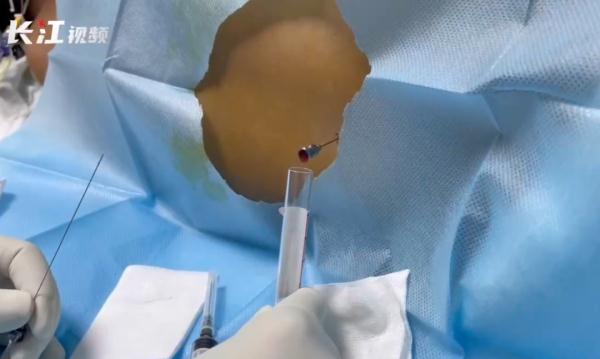 致死率超95%!14岁少年野泳后感染“食脑虫”,医生提醒 致死率超95%!14岁少年野泳后感染“食脑虫”,医生提醒