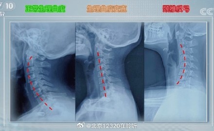 为什么低头对颈椎的破坏性这么大呢? 为什么低头对颈椎的破坏性这么大呢?