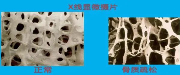 32岁女子咳断肋骨，医生：过度防晒导致的