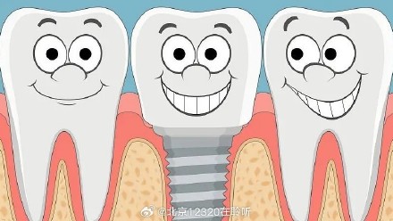 关于种牙，是缺几颗就能种几颗吗？