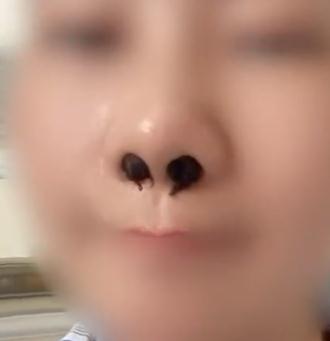 从没想过的事!因爱抠鼻子,女子鼻内长10多团… 从没想过的事!因爱抠鼻子,女子鼻内长10多团…