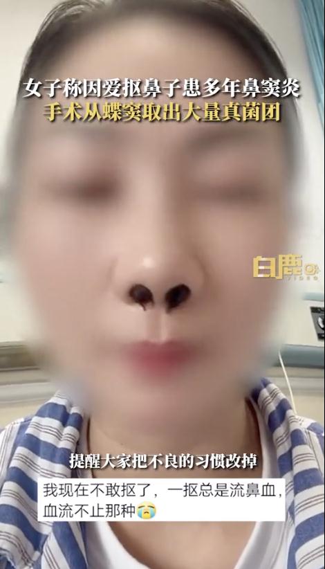 从没想过的事!因爱抠鼻子,女子鼻内长10多团… 从没想过的事!因爱抠鼻子,女子鼻内长10多团…