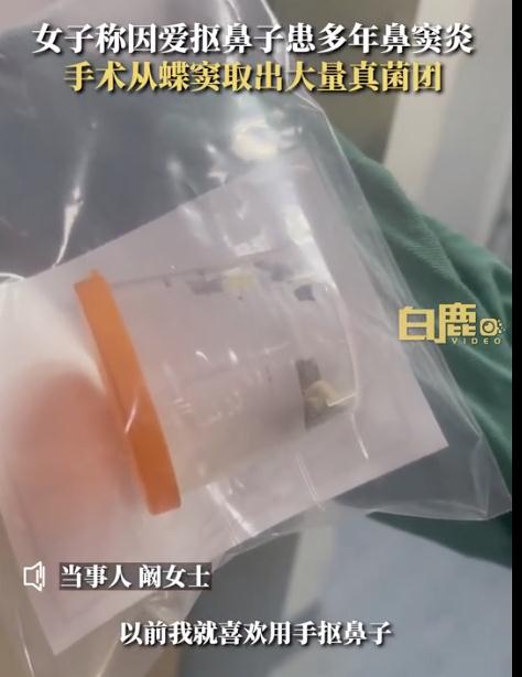 从没想过的事!因爱抠鼻子,女子鼻内长10多团… 从没想过的事!因爱抠鼻子,女子鼻内长10多团…