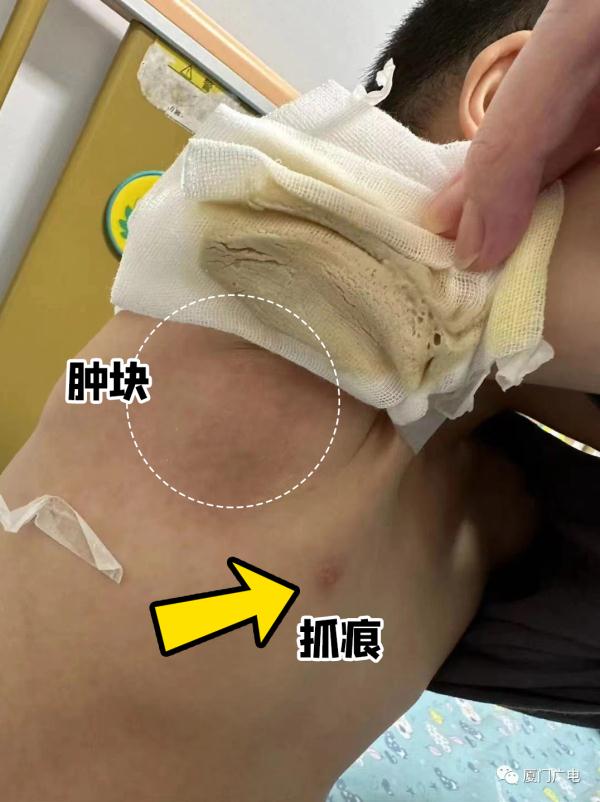 养猫的注意!厦门5岁男孩“撸猫”后得怪病! 养猫的注意!厦门5岁男孩“撸猫”后得怪病!