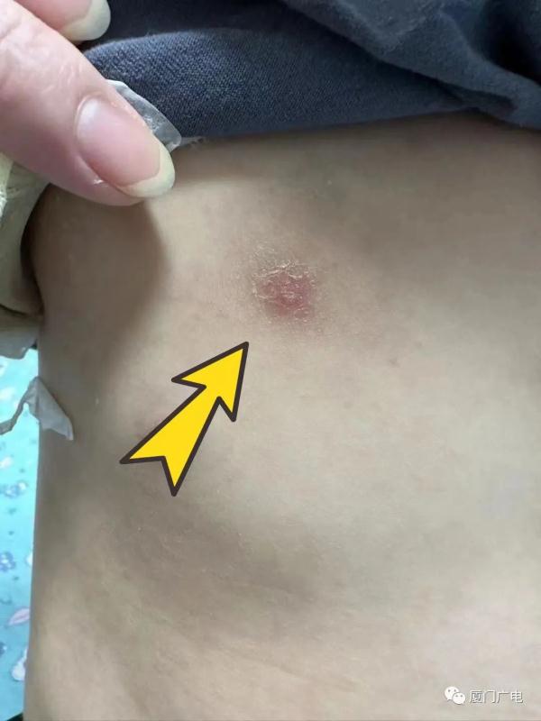 养猫的注意!厦门5岁男孩“撸猫”后得怪病! 养猫的注意!厦门5岁男孩“撸猫”后得怪病!