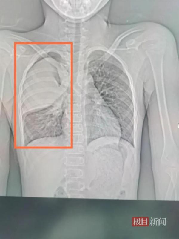 高烧4天,3岁娃查出“白”肺!近期很多孩子中招→ 高烧4天,3岁娃查出“白”肺!近期很多孩子中招→