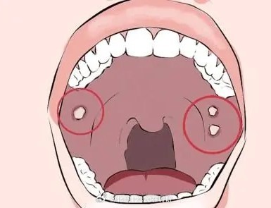 防止老年人发生口腔癌，关注口腔黏膜变化