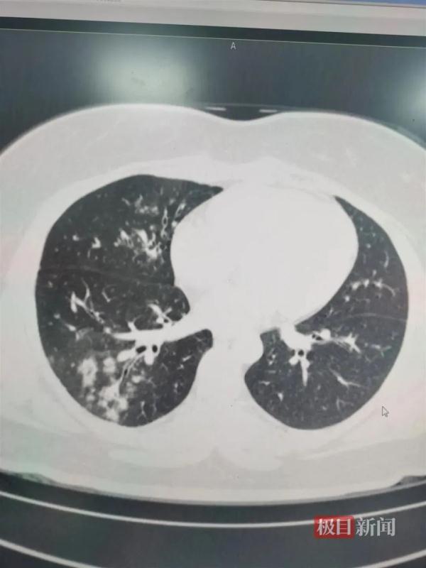 高烧4天,3岁娃查出“白”肺!近期很多孩子中招→ 高烧4天,3岁娃查出“白”肺!近期很多孩子中招→