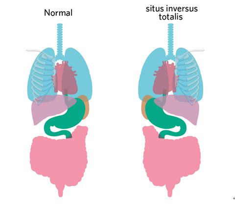 罕见!女子就医,竟发现五脏六腑反着长…… 罕见!女子就医,竟发现五脏六腑反着长……