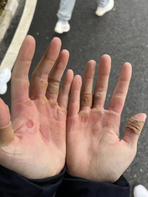 这双冠军的手,让人心疼! 这双冠军的手,让人心疼!